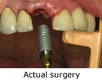 Actual Surgery image showing placement of dental implant