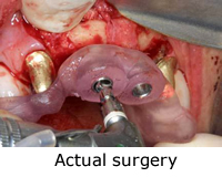 Actual Surgery image showing teeth in an hour surgery